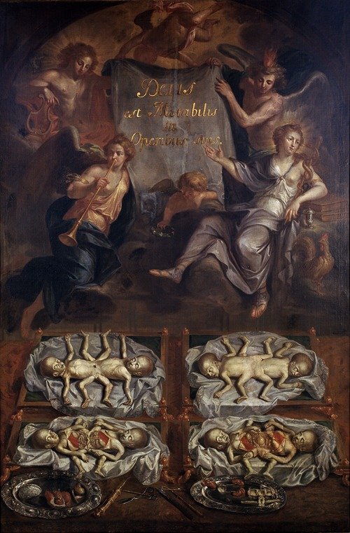 Dissection of Siamese Twins (1703)